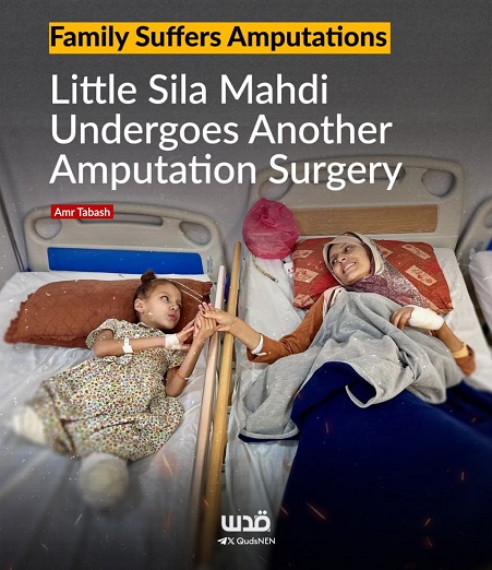 Amputationen im
                  Gazastreifen-KZ am 22.6.2025 - 14:57h: zum Beispiel
                  nach Bombardierungen gegen Zelte durch die
                  Killer-Zion-Armee - Familie Mahdi im Zeltlager von
                  Al-Mawasi - Amputationen wegen Mangel an medizinischer
                  Ausr�stung (!)