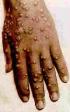 Pocken an Hand;
variole, viruelas, smallpox Pocken an Hand; variole,
viruelas, smallpox